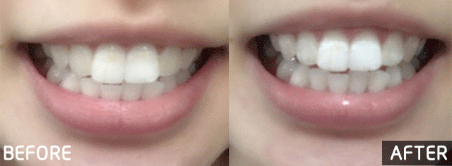 凤凰网梧桐汇商城|花1分钟贴一片,1小时拯救“老烟枪”几十年黄牙,坚持2周白一整年