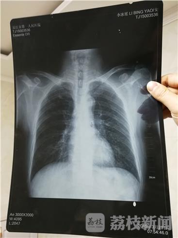 六旬男子患肺癌去世患病前体检胸片变女性