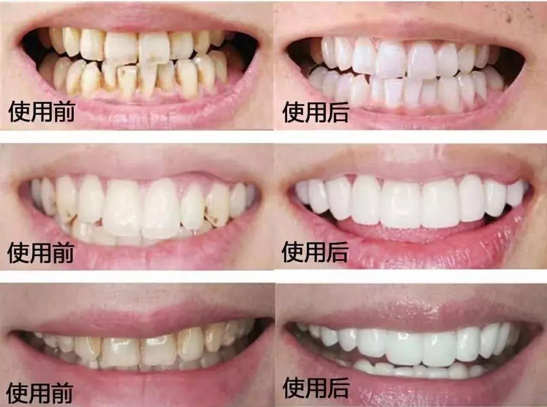 长效牙齿美白，什么方法比较好，除洗牙外？ - 知乎