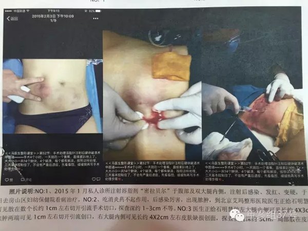 　　▲石女士被注射部位出现溶脂后皮肤脓肿合并感染现象，经诊断为脂肪溶解坏死。 资料图片