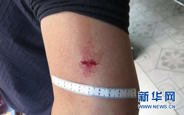 杜华在制服嫌疑人时受伤