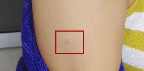 　　女子被扎部位