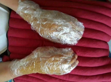 什么是湿疹及症状图片