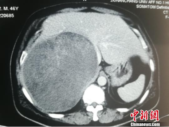 江西一男子腹胀术后腹内取出8.2斤巨型肿瘤（图）