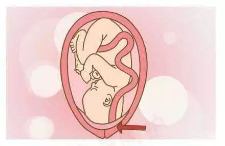 40岁高龄孕妈第三胎妊娠遇凶险性前置胎盘 海