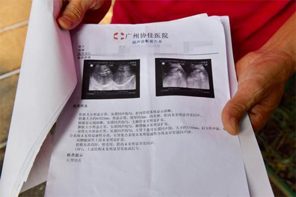 左肾结石怎么治疗和取石 b9cbff01af4f92e_w600_h400.jpg