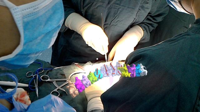 &ldquo;全球首例混合现实引导下脊柱畸形矫形手术&rdquo;在西安完成