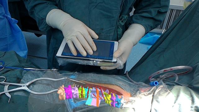 &ldquo;全球首例混合现实引导下脊柱畸形矫形手术&rdquo;在西安完成