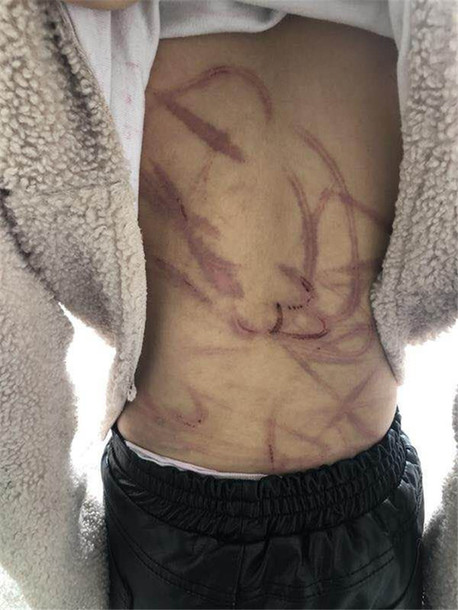 扬州一10岁女童疑遭家暴全身有数十道血痕