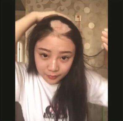 美女电钻啃玉米变秃顶去看医生:真悲剧了