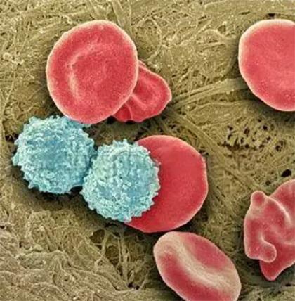 图为:显微镜下的白血病癌细胞