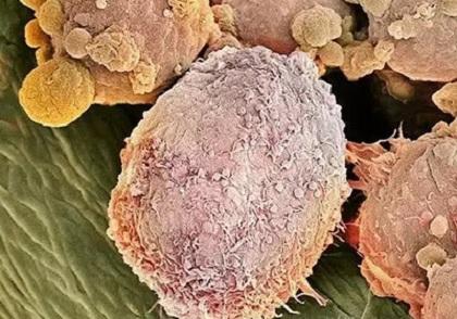 看显微镜下的各类癌细胞:画风完全不一样