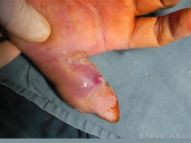 劝架时意外被咬到手指 男子险些截指_湖北频道_凤凰网