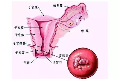 宮頸癌形成的原因