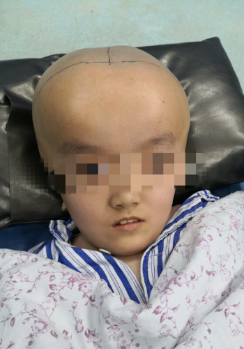 甘肃巨头娃娃在湖南接受手术 新脑袋被成功缩小7厘米
