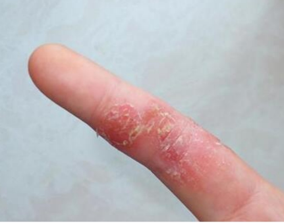 成人长湿疹的原因有哪些?老中医忍痛说出祛湿秘籍