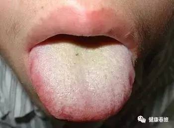 舌头底部出现这现象你离脑血管病不远了