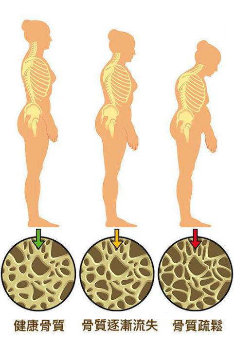 为什么绝经后的女性更容易得骨质疏松
